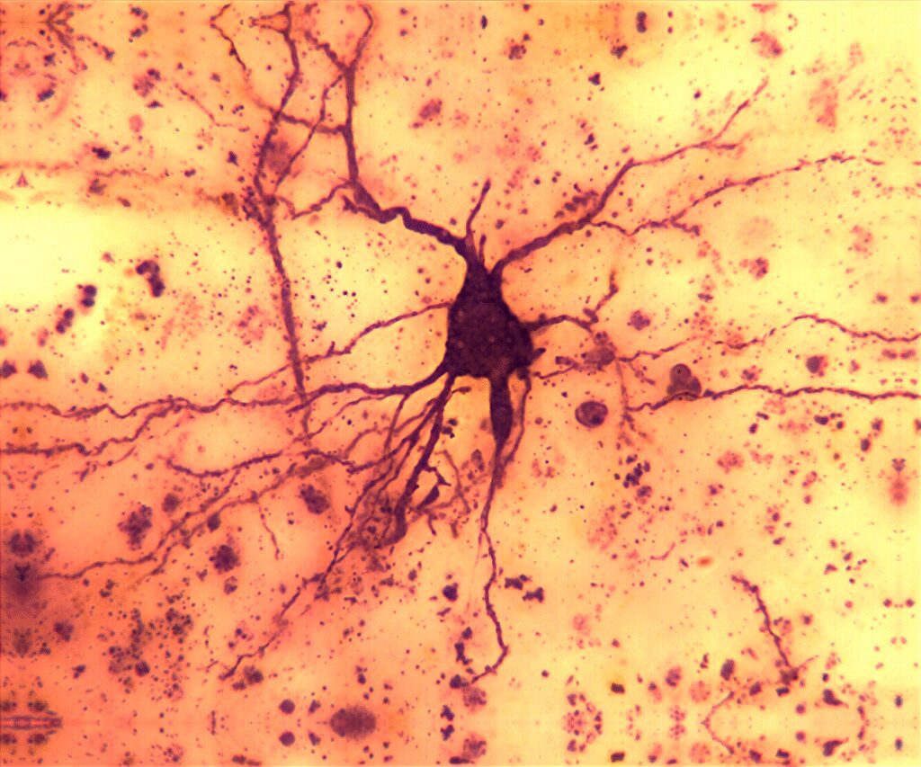 hippocampal tissue from Alzheimer brain