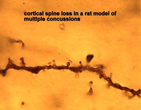 Cerebral Ischemia